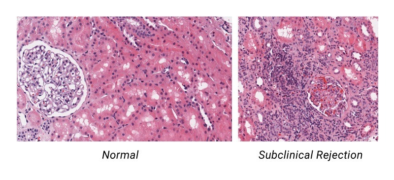 normal vs subclinical allograph rejection of organ transplants - microscopic image